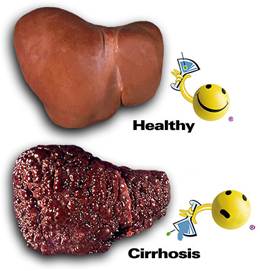 cirrhosis-ti-1.jpg